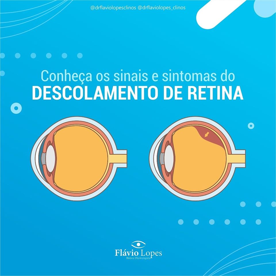 Deslocamento de retina!