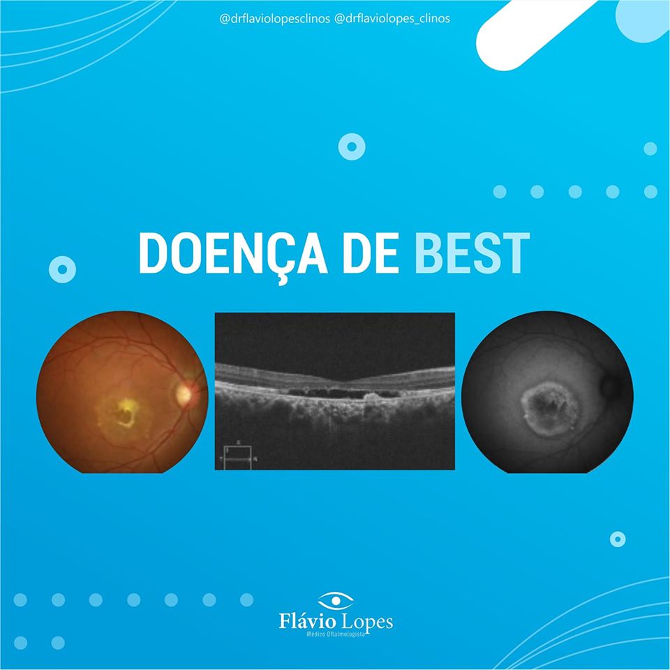 Você sabe o que é doença de best?