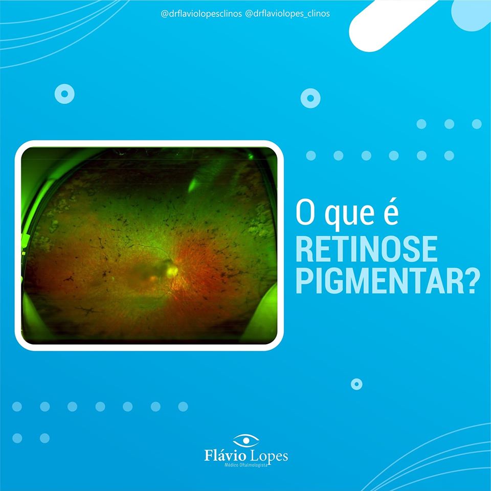 O que é retinose pigmentar?