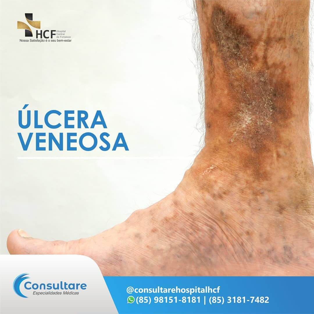 Úlcera Nervosa