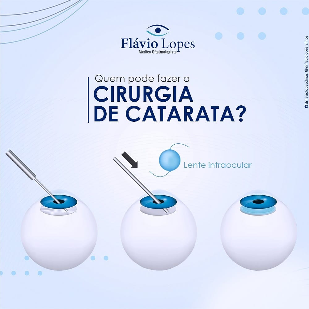 Você tem dúvidas sobre a catarata?