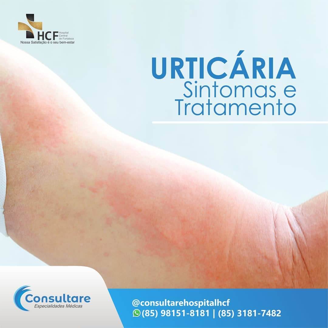 Sintomas e tratamento Urticária