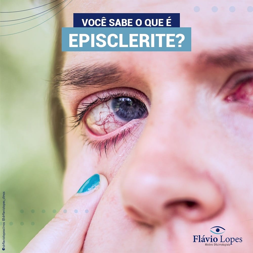 Agora vamos entender sobre o que é Episclerite.