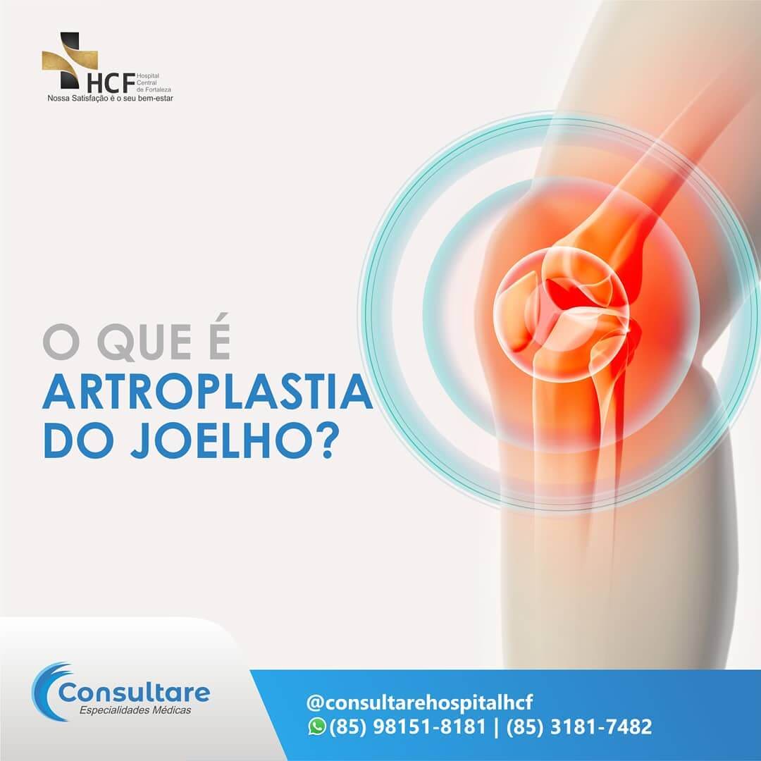 O que é Artroplastia do Joelho?