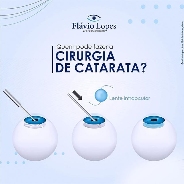 Quem pode fazer a cirurgia de catarata?