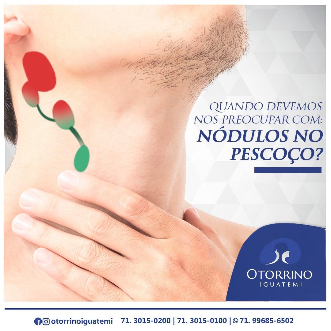 OTORRINO IGUATEMI:  Os nódulos no pescoço