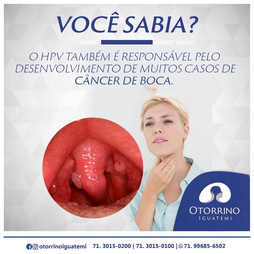 OTORRINO IGUATEMI: O HPV