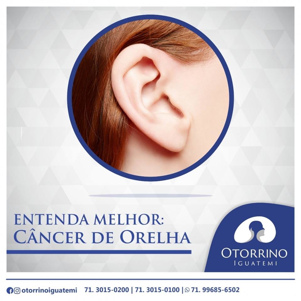Otorrino Iguatemi - Saiba mais sobre o câncer de orelha!