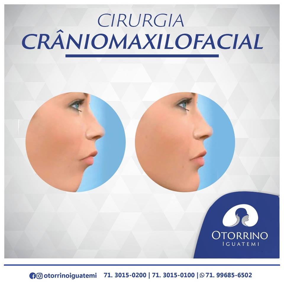 Otorrino Iguatemi explica o que é a cirurgia crâniomaxilofacial!