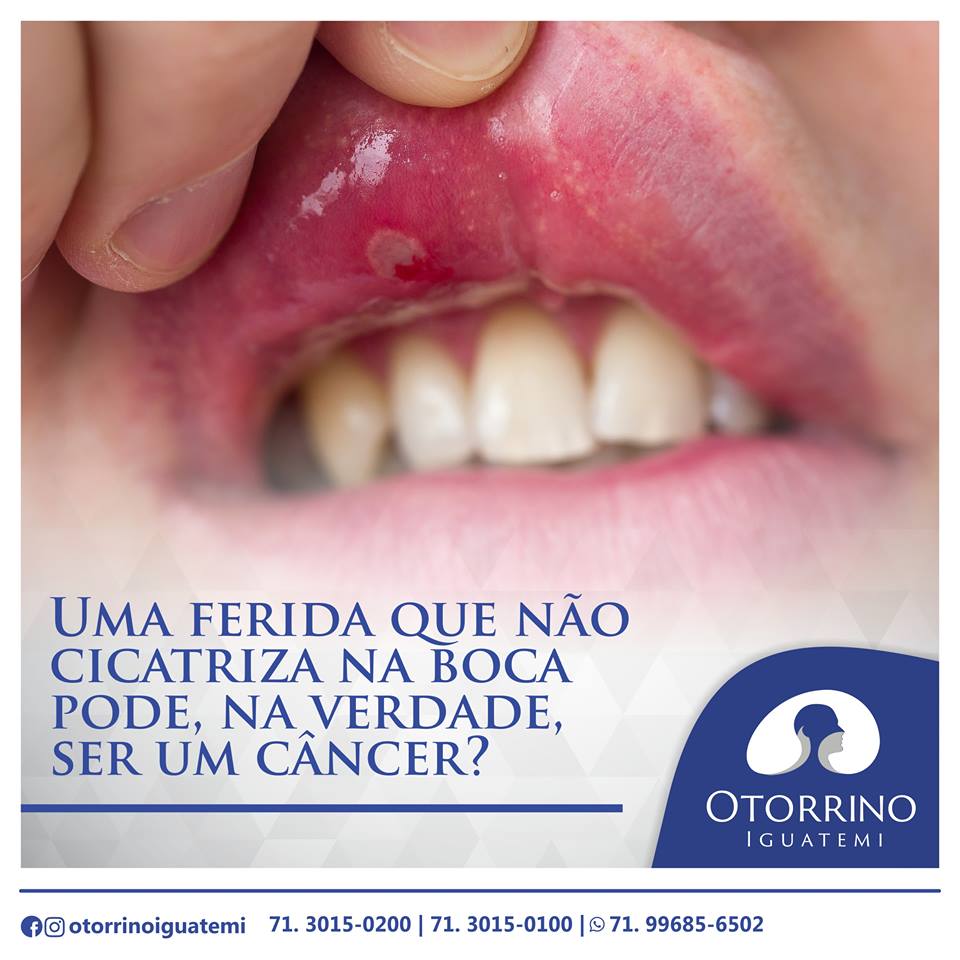 Otorrino Iguatemi - Ferida que não cicatriza na boca. Devo me preocupar?