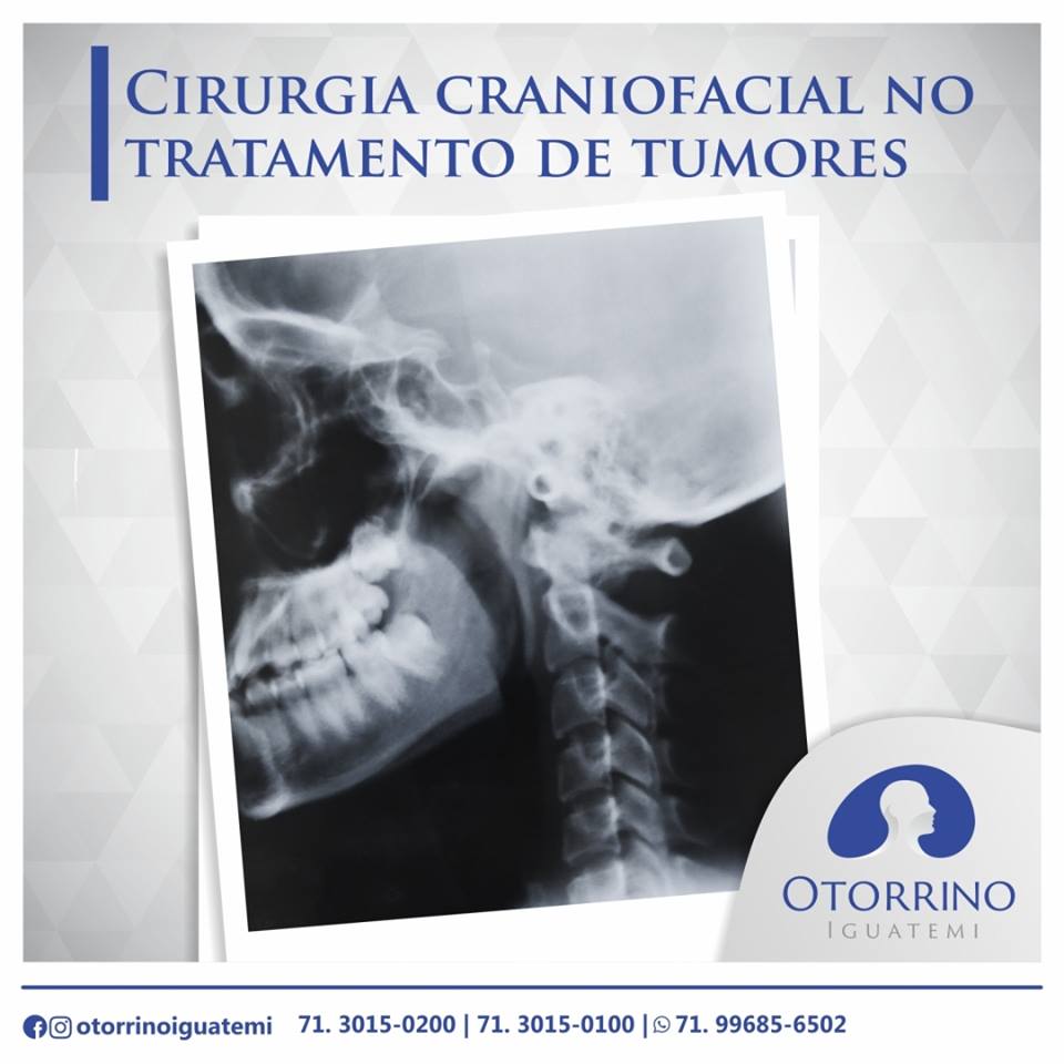 Cirurgia craniofacial