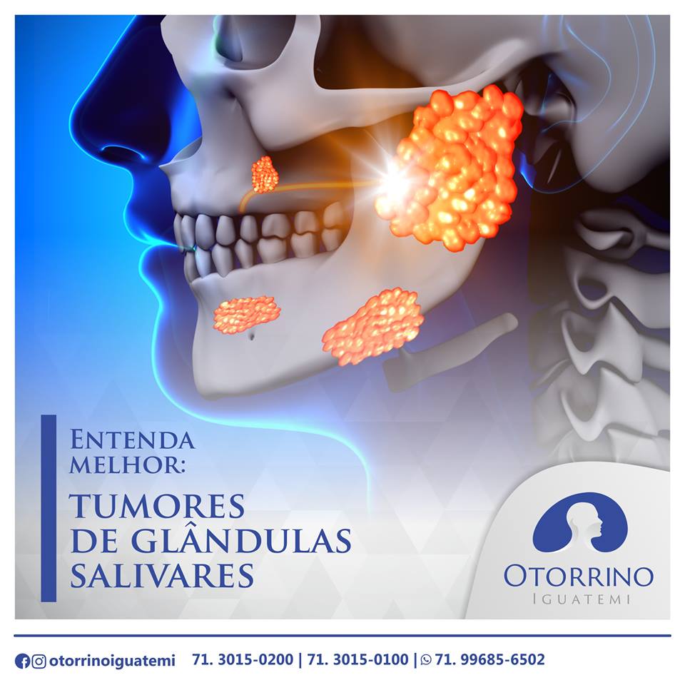 Tumores de glândulas salivares