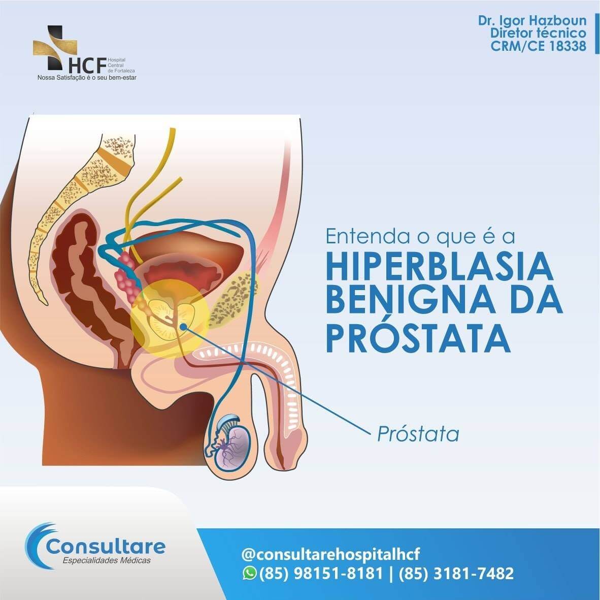 O que é Hiperblasia Benigna da Próstata?