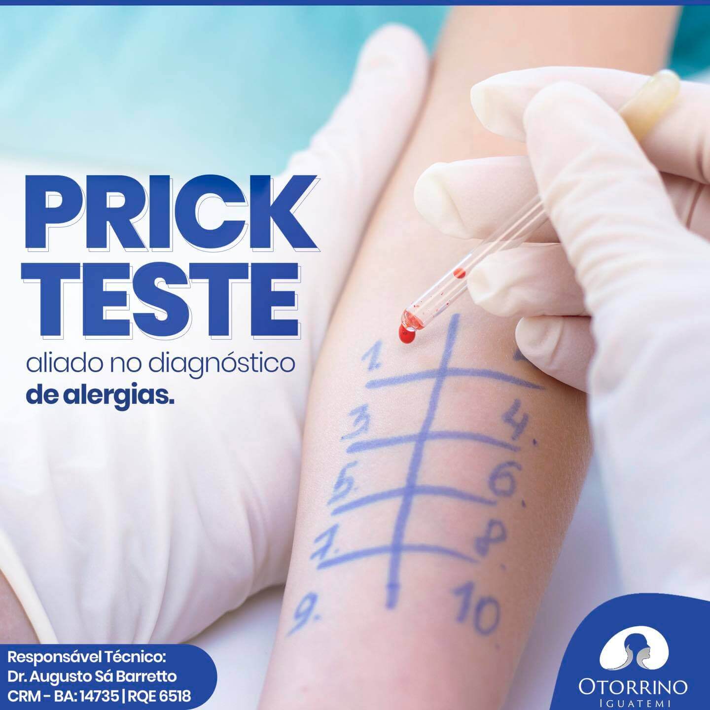 Prick Test - diagnóstico de alergias