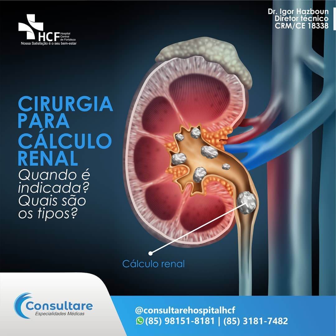 Cirurgia para Cálculos Renais