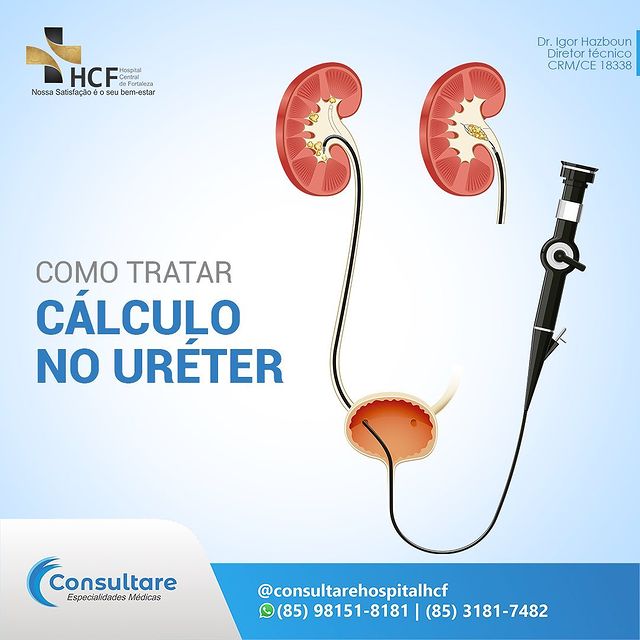 Como tratar cálculo no ureter?