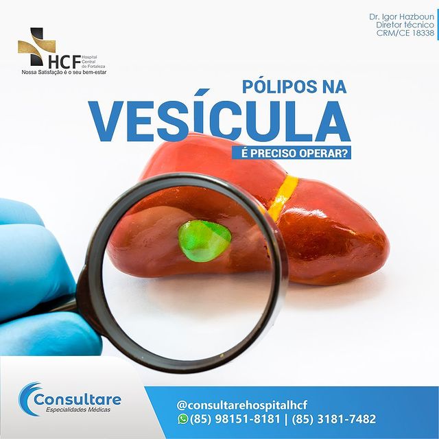 Pólipos na vesícula. É preciso operar?