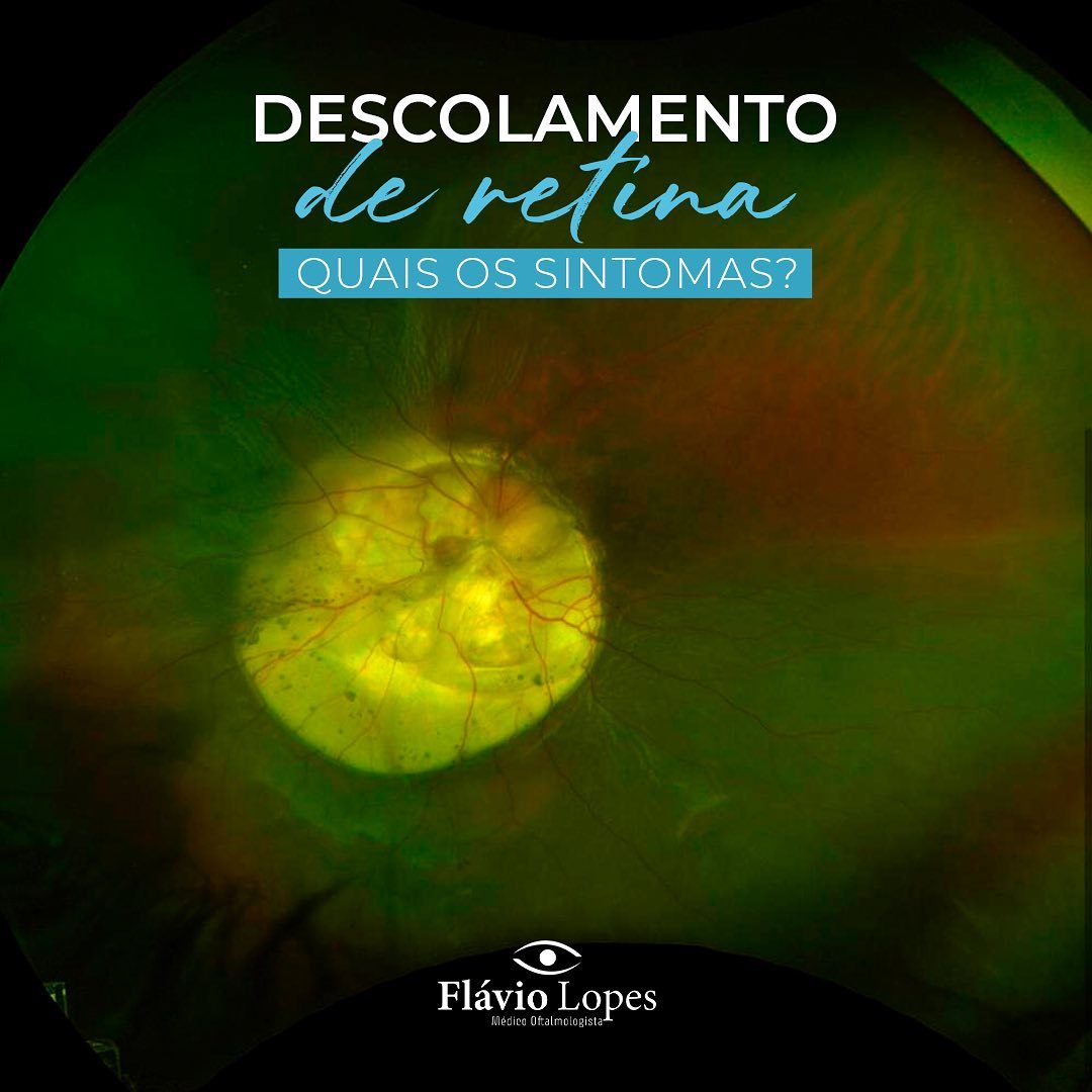 Quais os sintomas do deslocamento de retina?