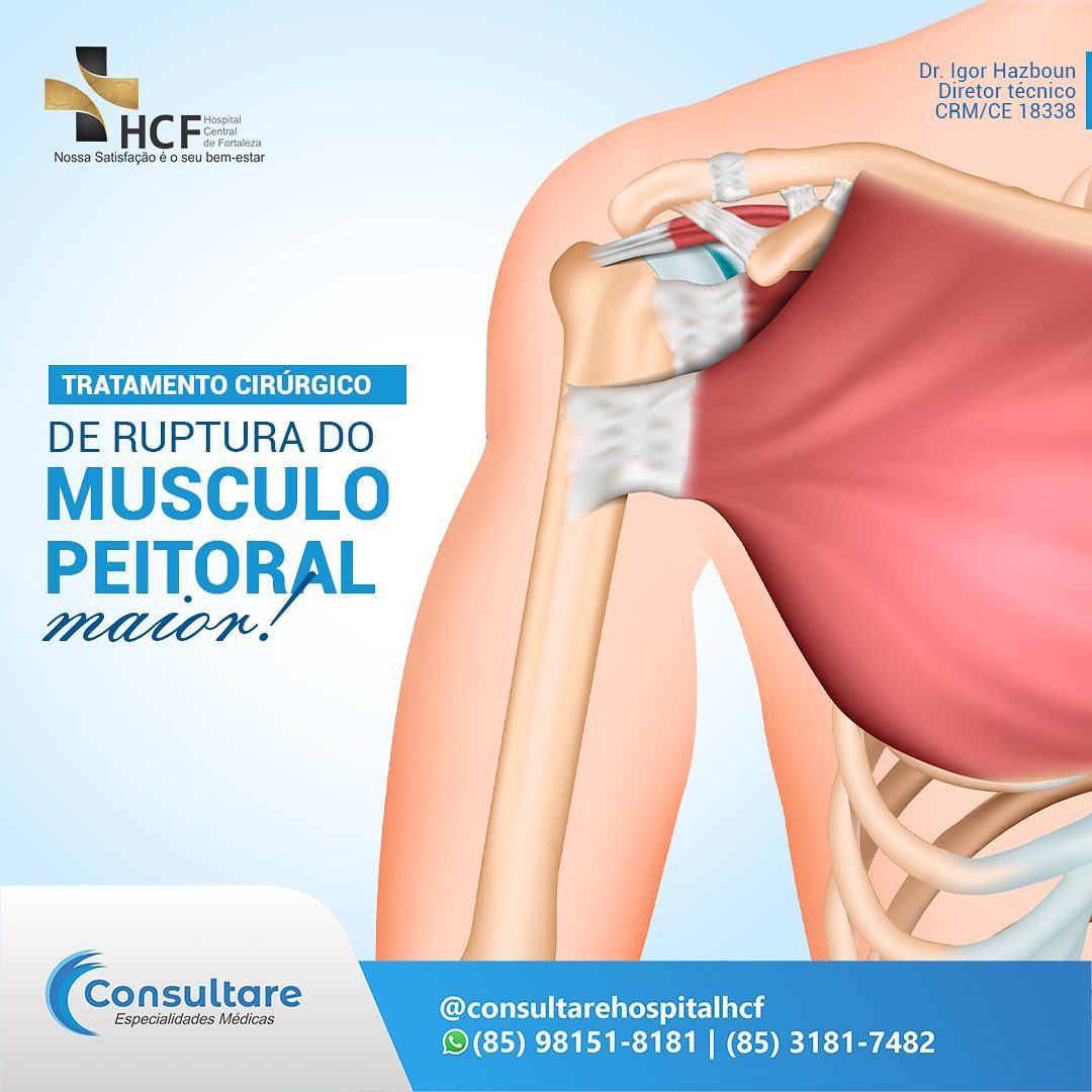 O que é um músculo temporal?