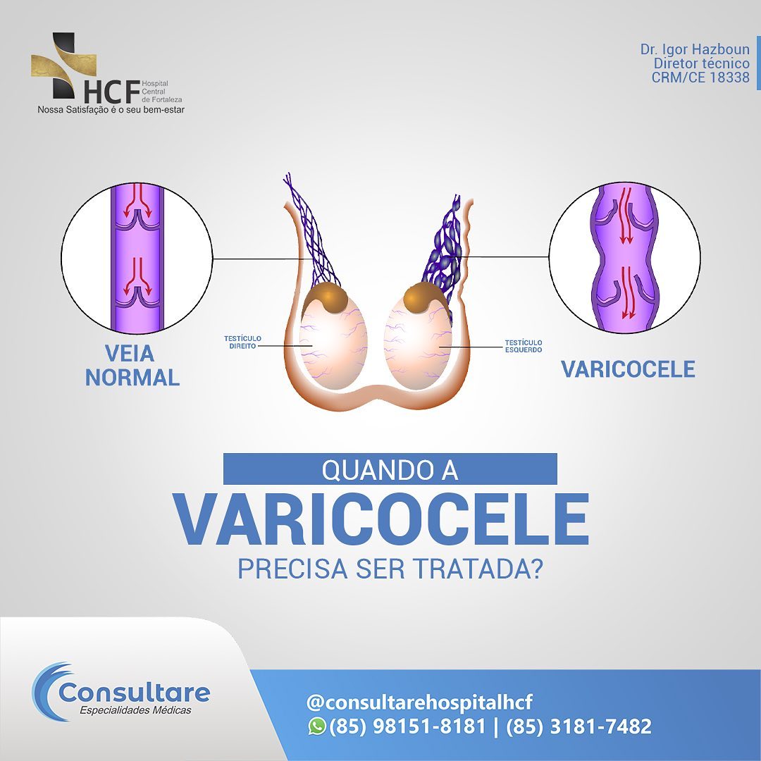 Quando a varicocele deve ser tratada?