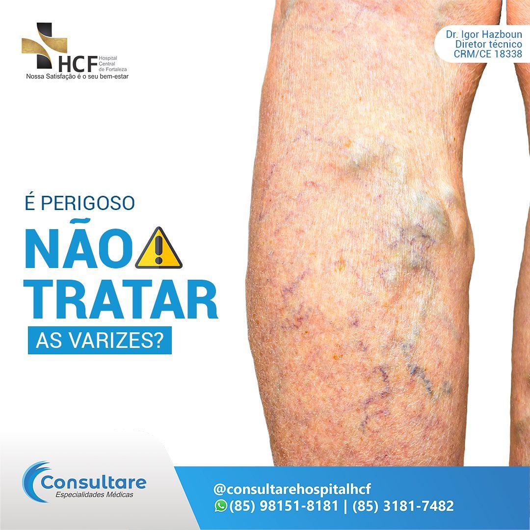 Quais são os riscos das varizes?