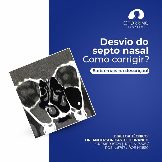 Desvio  de septo nasal como corrigir?