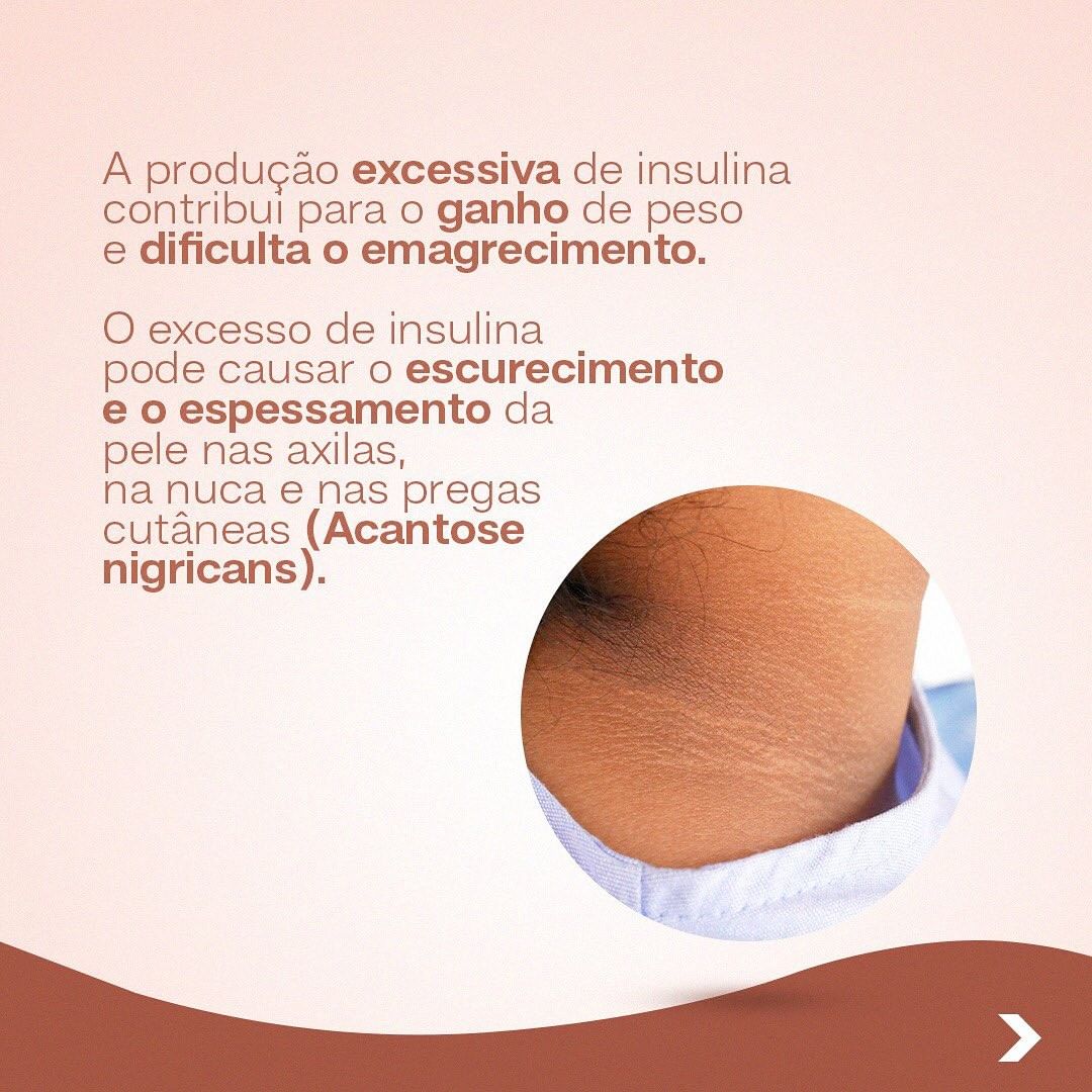 Já ouviu falar de Acantose Nigricans ? Vamos entender melhor!