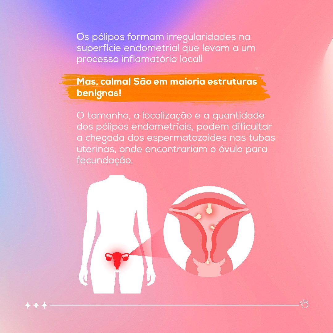 Como identificar os pólipos endometriais?