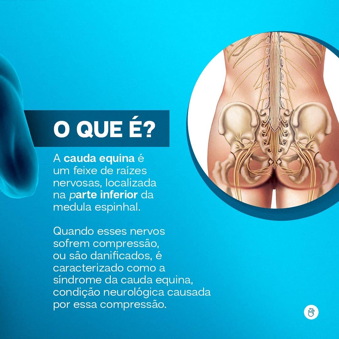 Síndrome da cauda equina!