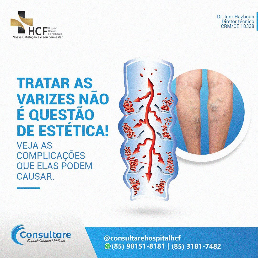 Tratar das varizes não é uma questão de estética!