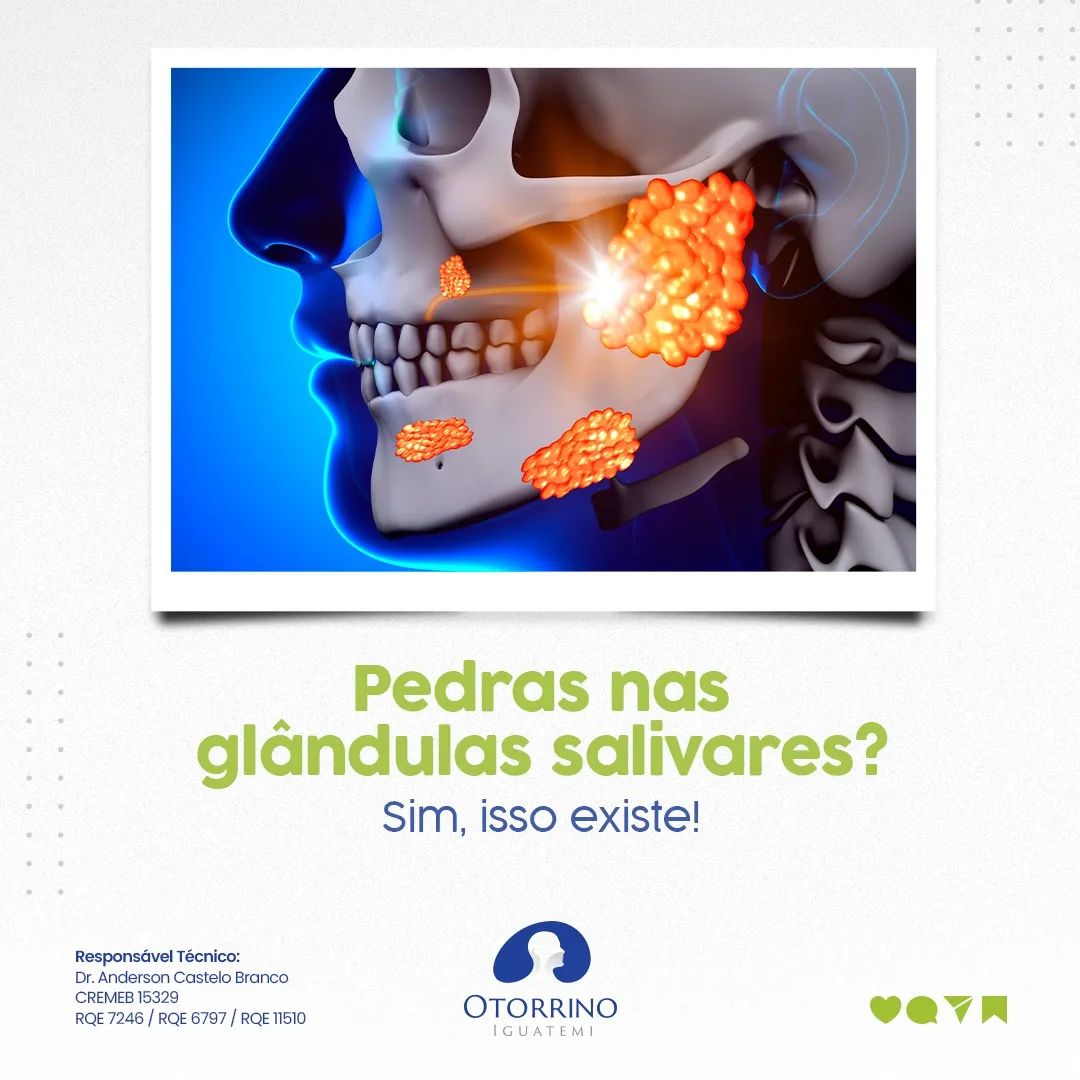 Existe  pedras  nas glândulas  salivares?
