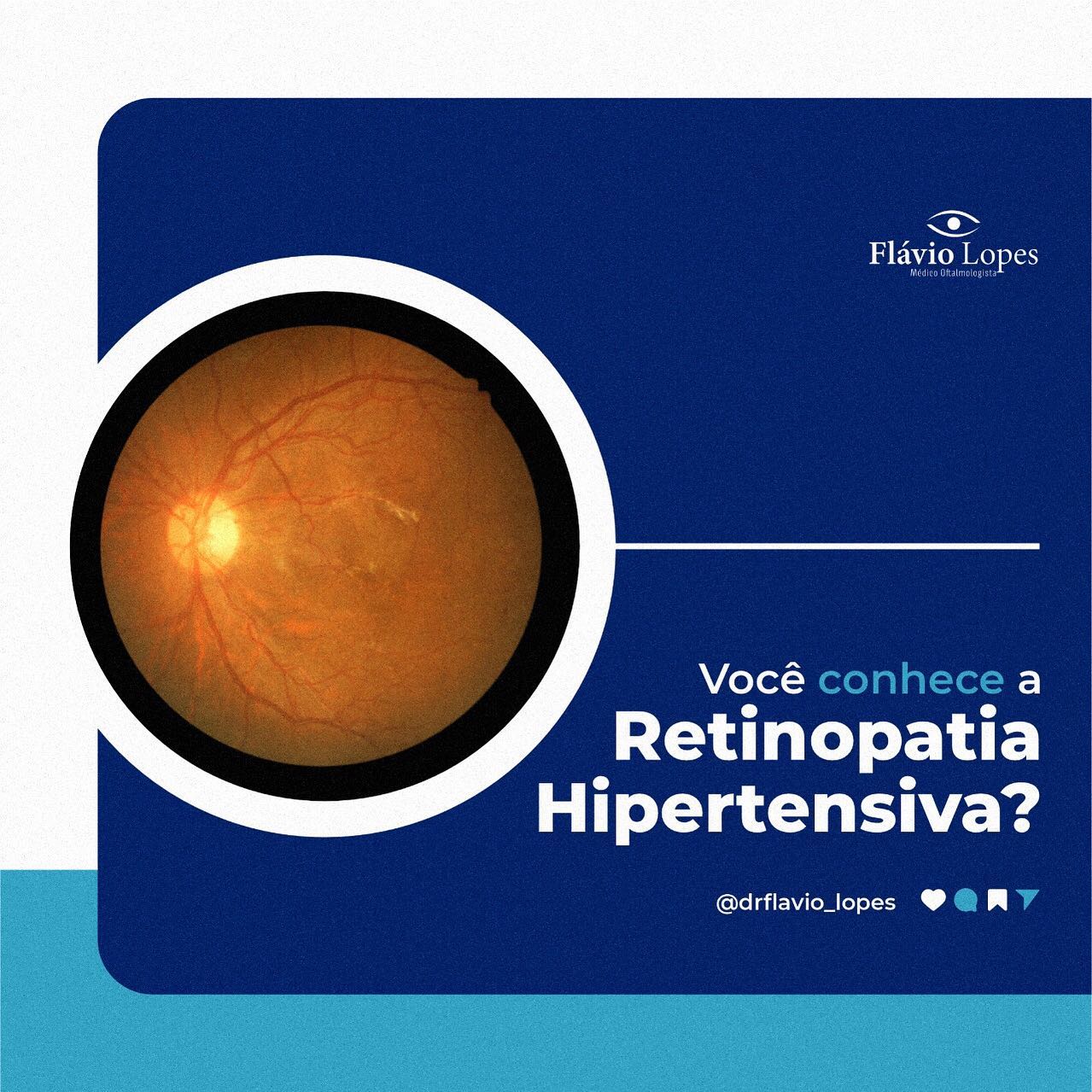 O tratamento para a retinopatia hipertensiva é manter a pressão arterial sob controle.