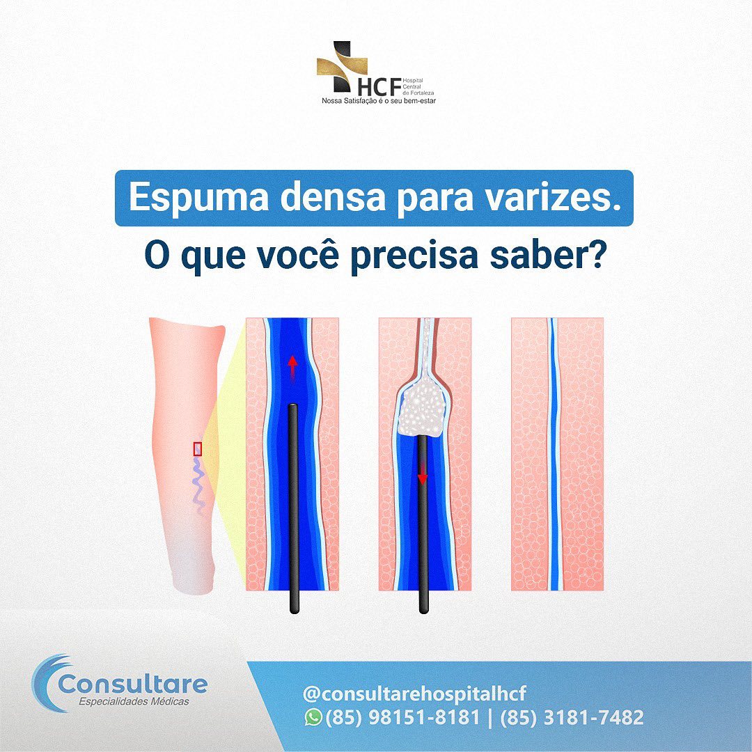 Você tem histórico de varizes?