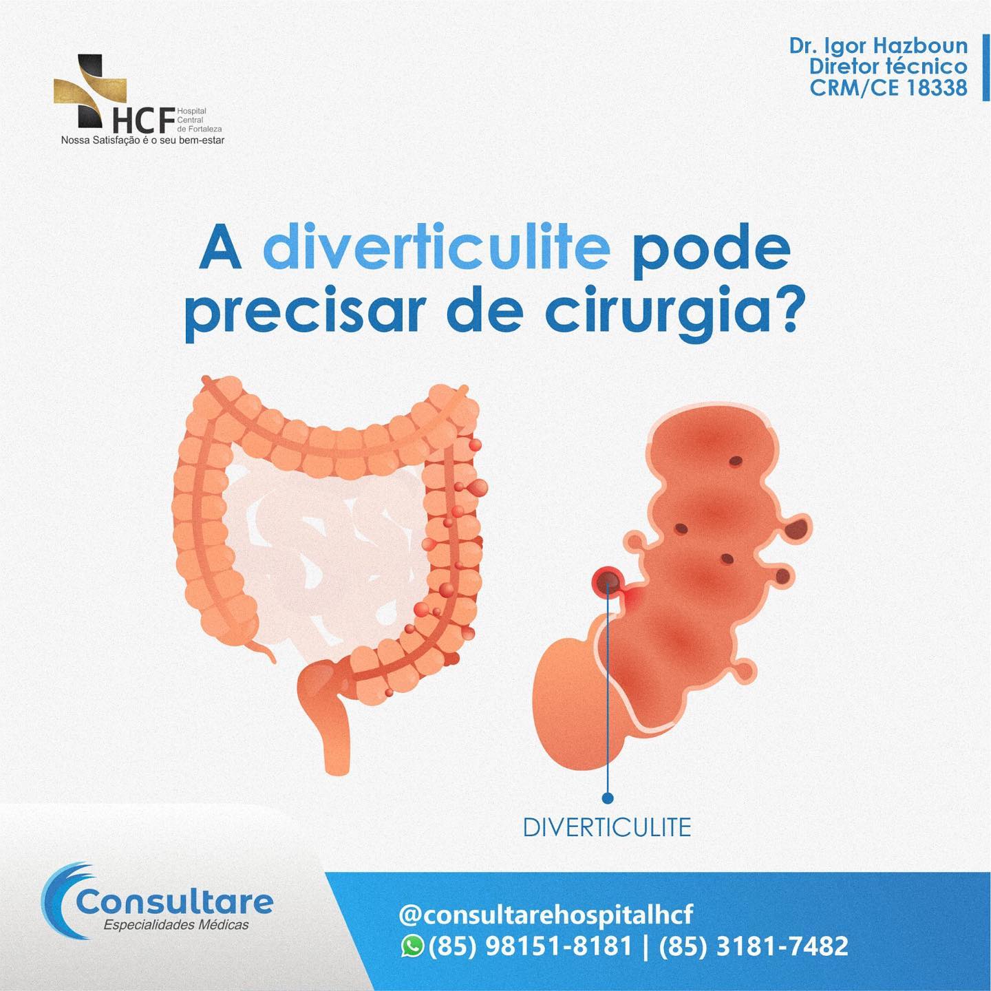 Pode se feito   cirurgia de diverticulite?