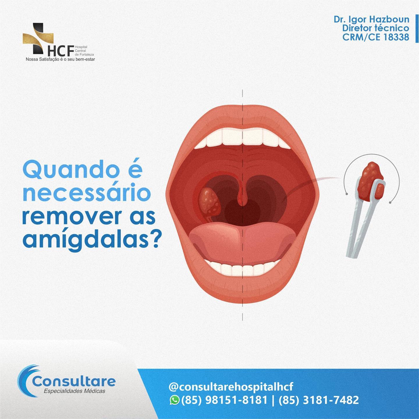 Quando é necessário  remover  amígdalas.