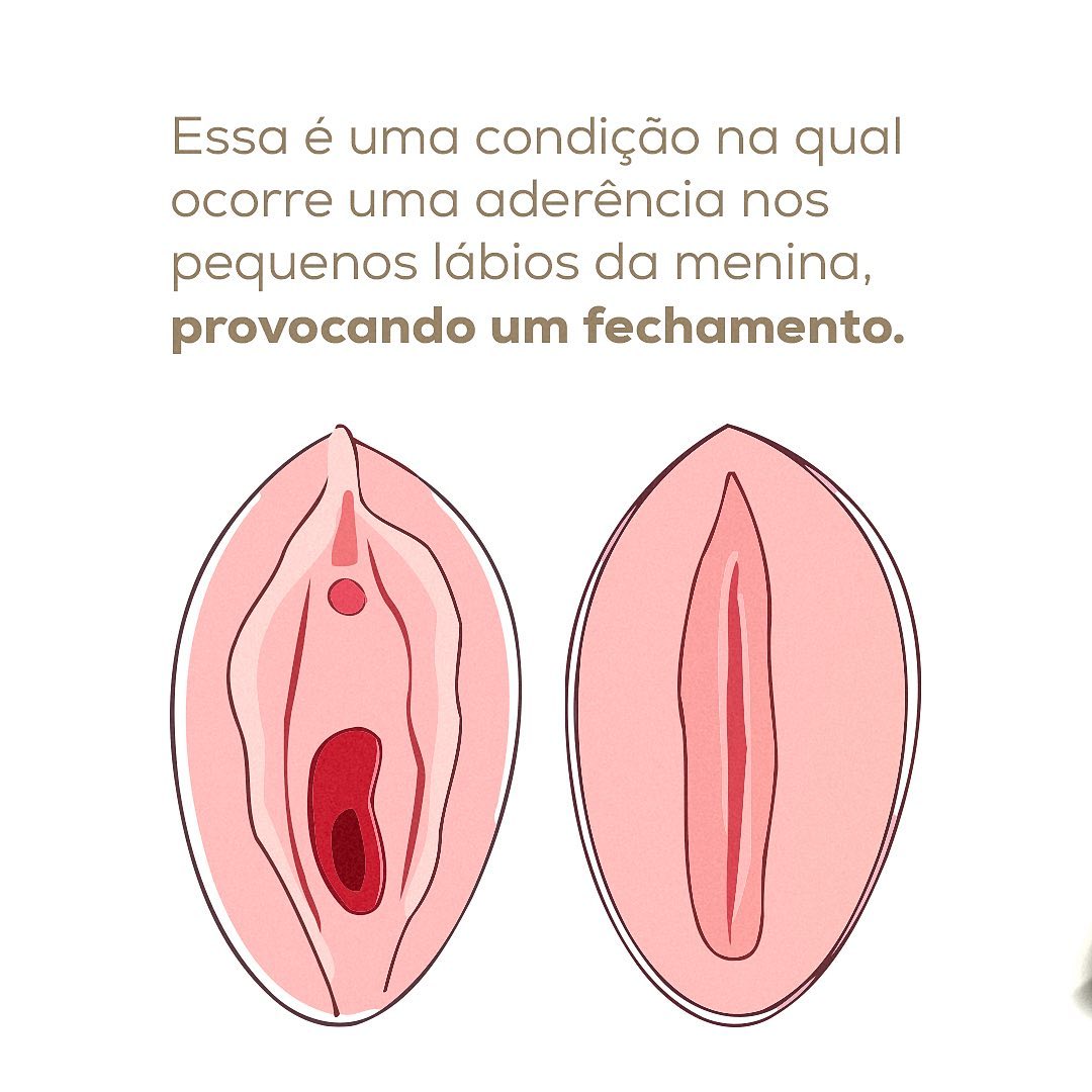 Alerta para as mães meninas.