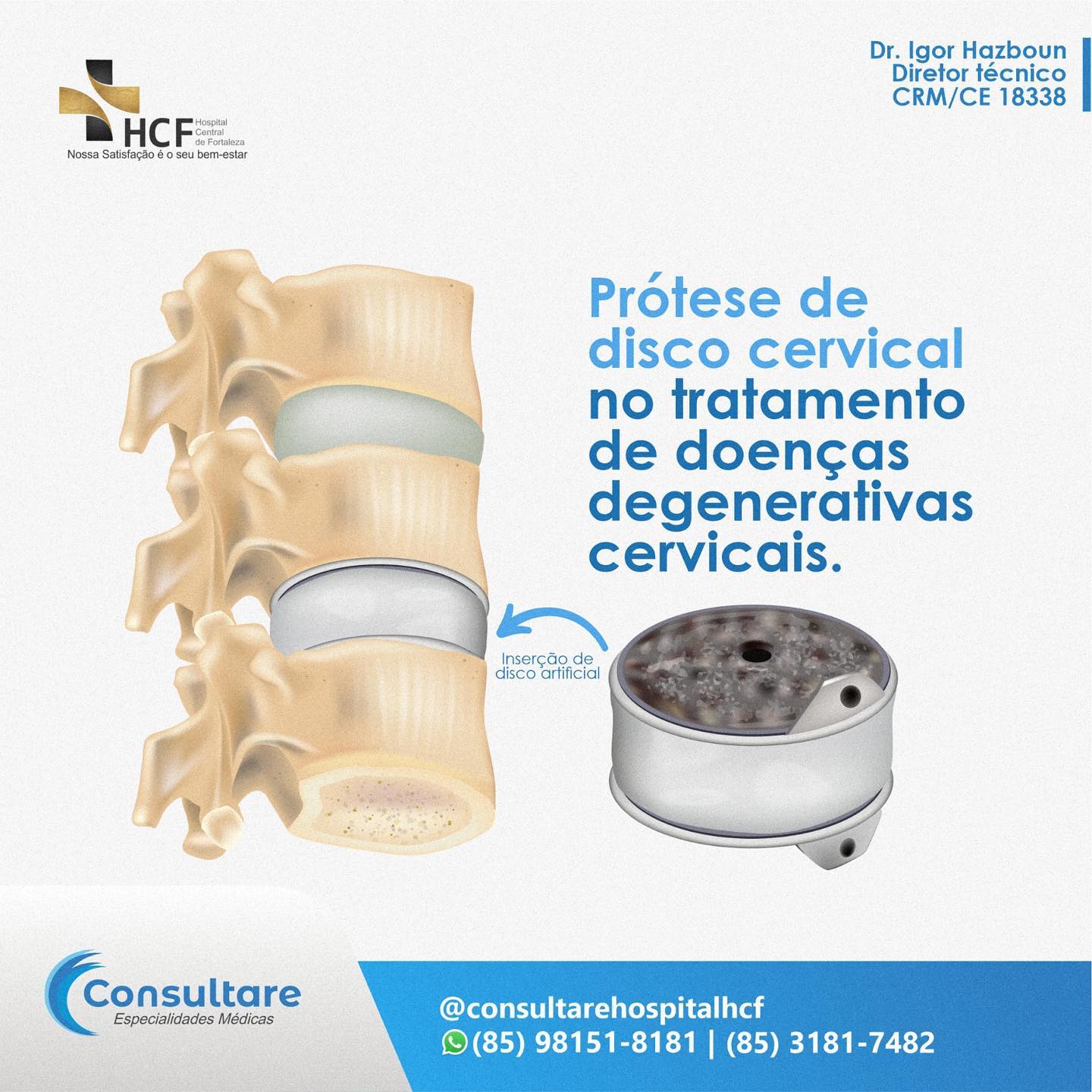 Dúvidas sobre as próteses artificiais de disco cervical? Conta aqui pra gente!