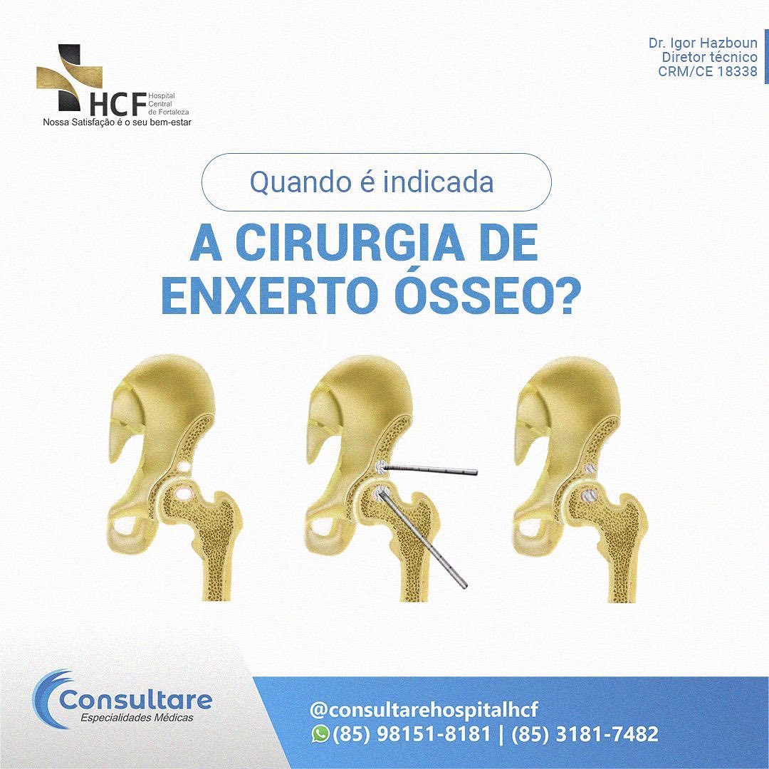 E você, já sabia que era possível realizar um enxerto ósseo?