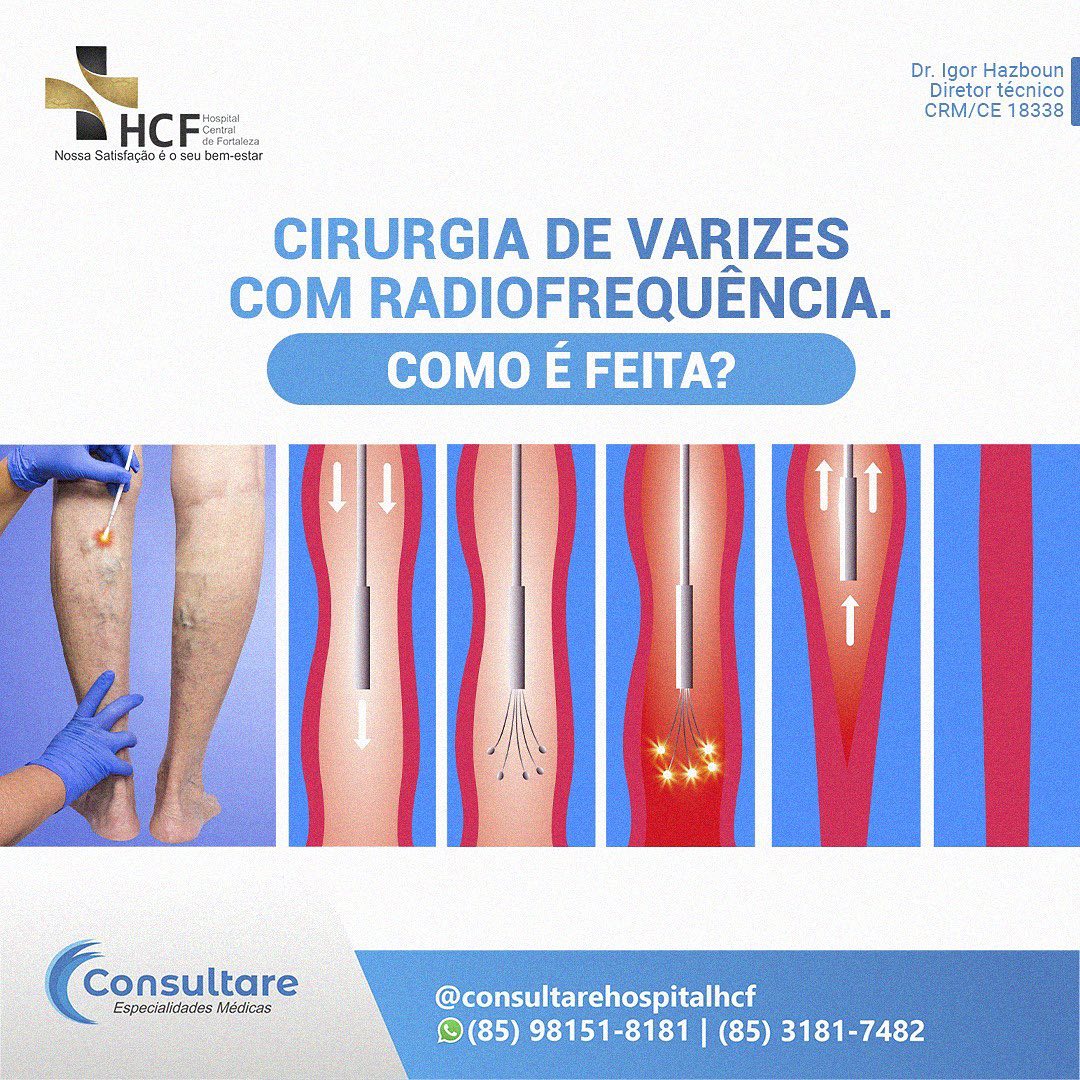 Como é feita a cirurgia de varizes com radiofrequência?