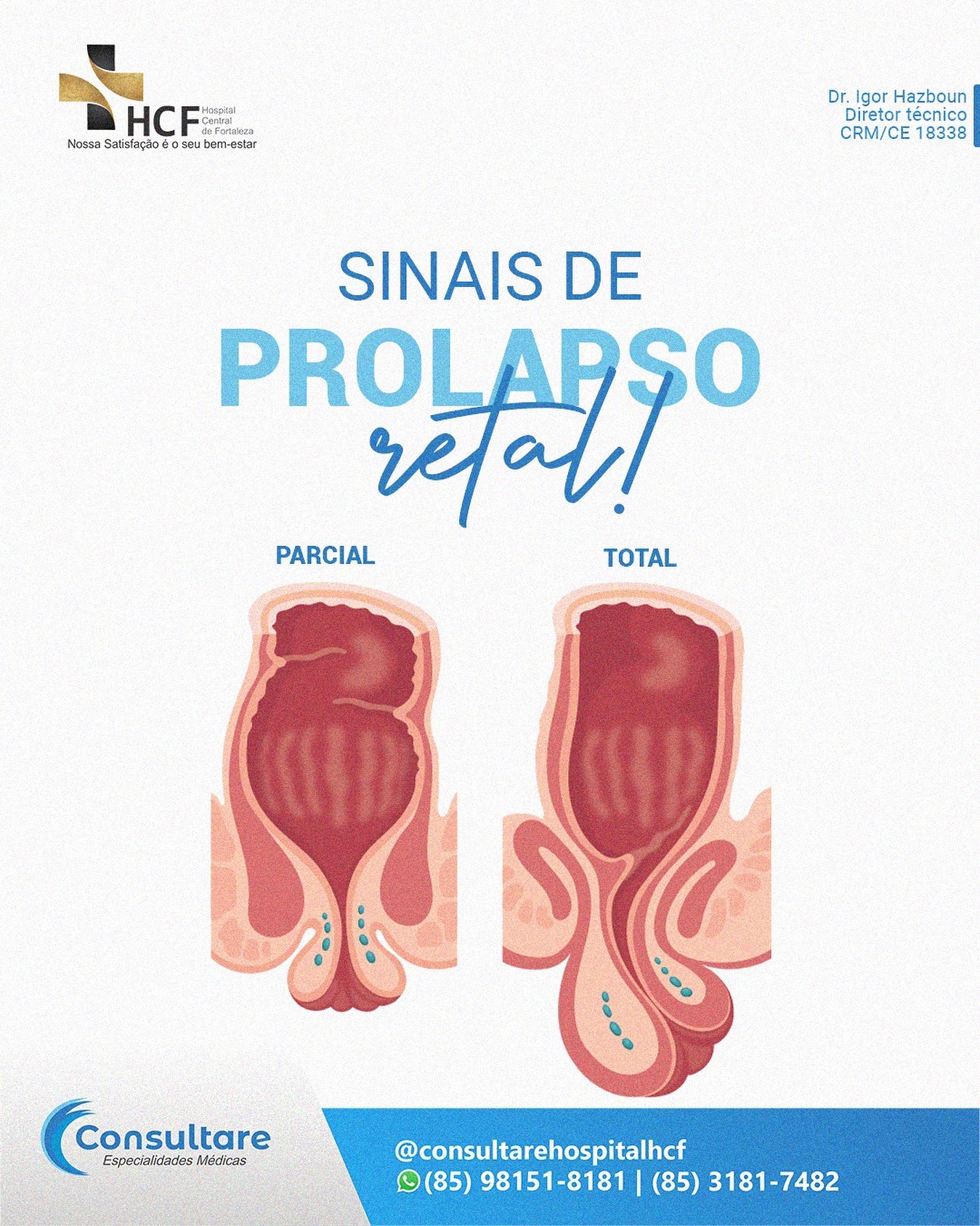 Como identificar um prolapso retal?